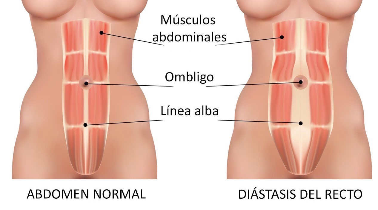 Abdomen antes y después de la diástasis abdominal