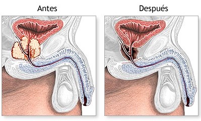 La próstata antes y después de una prostatectomía